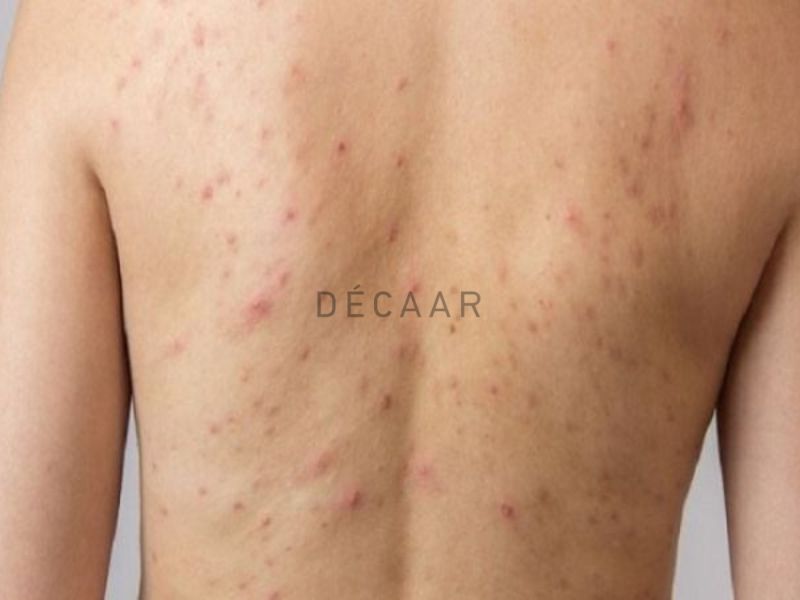 Mụn lưng tuổi dậy thì là một vấn đề rất phổ biến